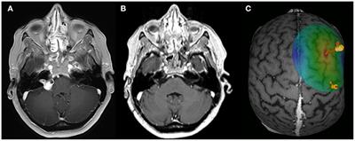 Repetitive Transcranial Magnetic Stimulation for Tinnitus Treatment in Vestibular Schwannoma: A Pilot Study